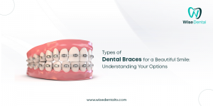 Types of Dental Braces for a Beautiful Smile: Understanding Your Options